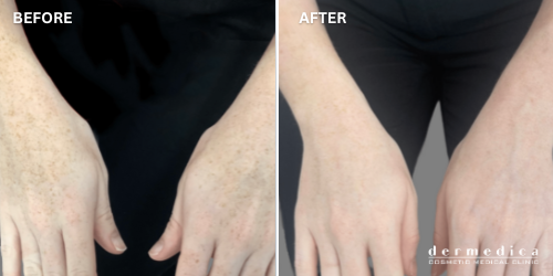 before and after ageing hands treatment in dermedica perth
