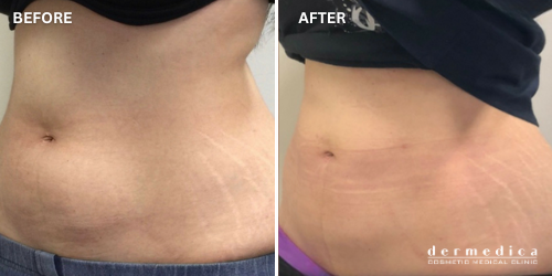 before and after body fat treatment dermedica perth