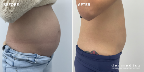 before and after body fat treatment perth dermedica
