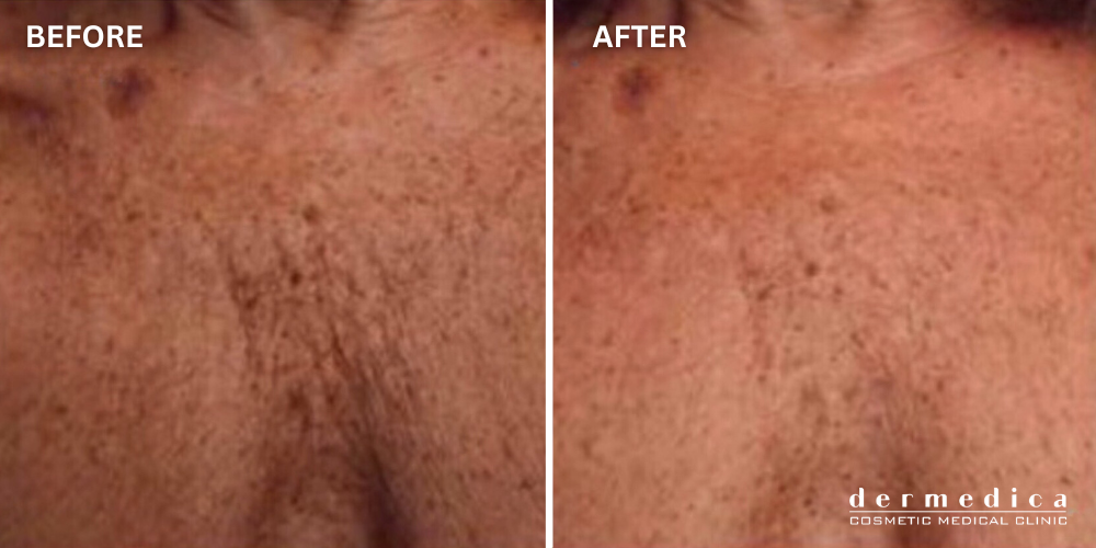 before and after chest lines in perth dermedica