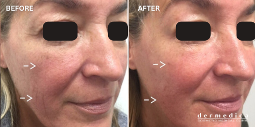before and after facelift treatment perth