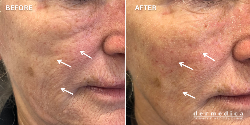 before and after facelift treatment australia