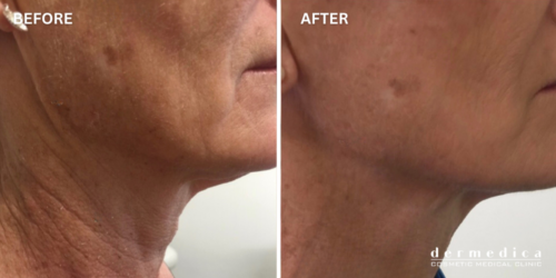 before and after neck lines treatment australia dermedica