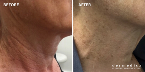 before and after neck lines treatment perth dermedica