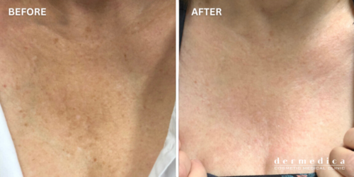 before and after neck/chest pigmentation treatment