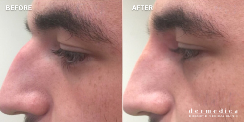 before and after non surgical nose fillers in perth