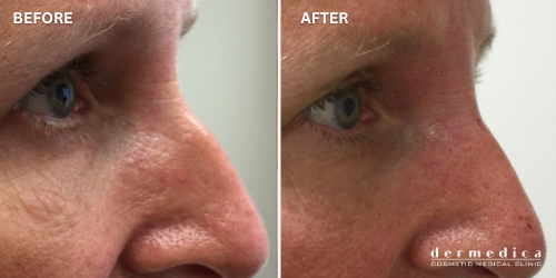 before and after non surgical nose fillers in australia