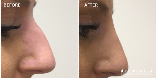 before and after non surgical nose fillers