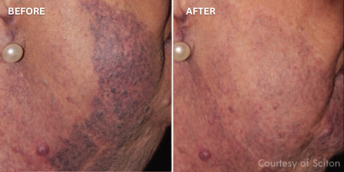 before and after rejuvaderm ageless treatment australia