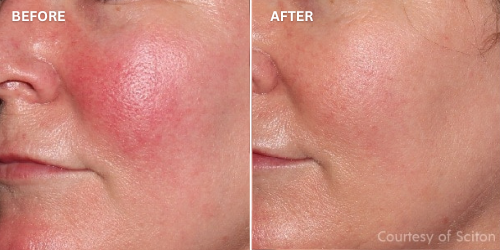 before and after rejuvaderm ageless treatment perth