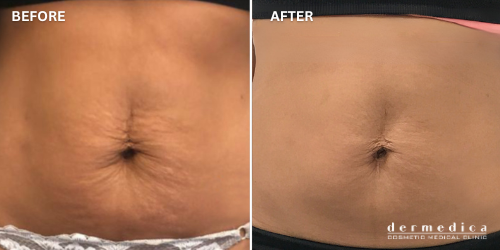 before and after stretch marks treatment in perth dermedica australia