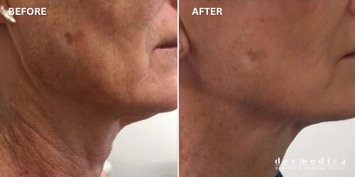 ultherapy skin tightening and face lift before and after