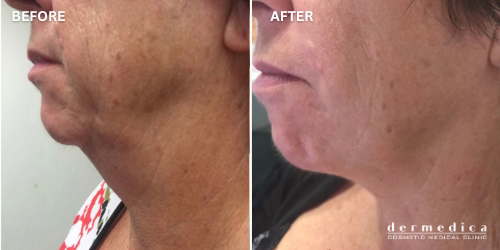 ultherapy before and after skin tightening & facelift