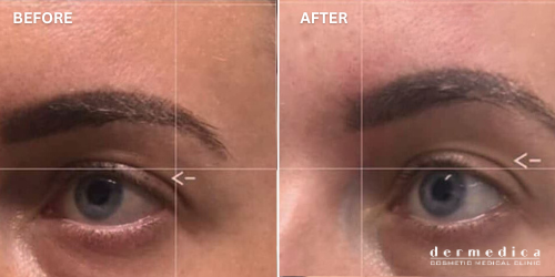 ultherapy before and after skin lifting and tightening