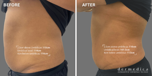 before and after trusculpt treatment in removing fats perth
