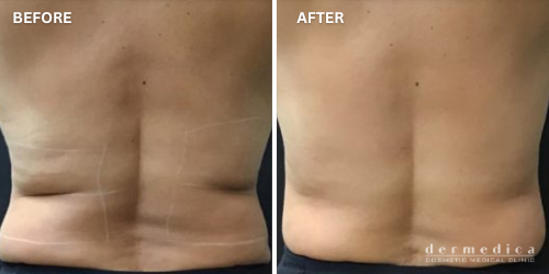 before and after trusculpt treatment in removing fats