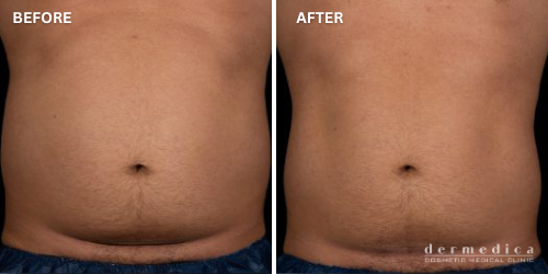 before and after abdominal treatment with trusculpt flex