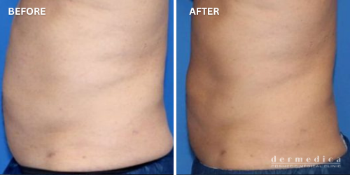 before and after belly treatment with trusculpt flex