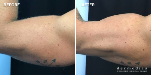 before and after arm fat treatment with trusculpt flex