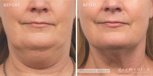 Before and after coolsculpting for double chin