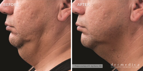 Before and after coolsculpting for double chin perth