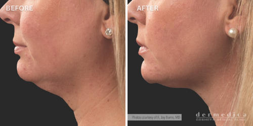 Before and after coolsculpting for double chin treatment