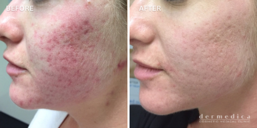 Before and after fractional resurfacing