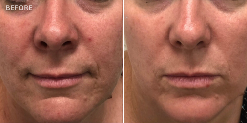 Before and after fractional resurfacing treatment