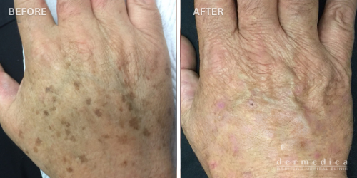 Before and after hand pigmentation treatment perth