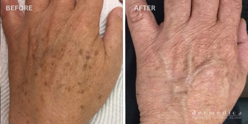 Before and after hand rejuvenation treatment perth