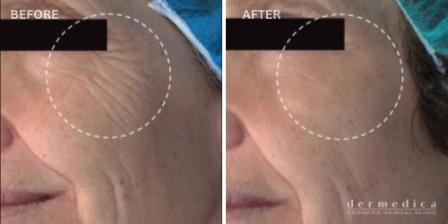 Before and after microneedling treatment in perth