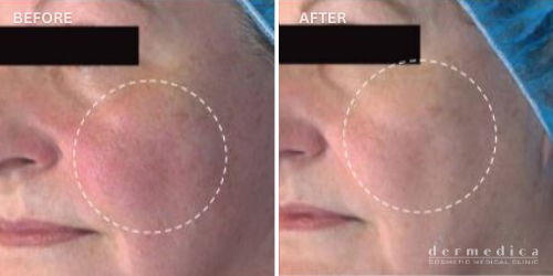 Before and after microneedling treatment dermedica