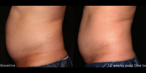 Before and after trusculpt id treatment